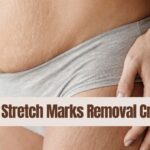 Best Stretch Marks Removal Cream