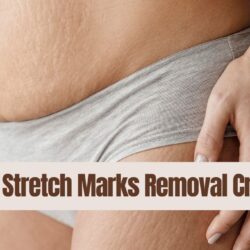 13 Best Stretch Marks Removal Cream: Say Goodbye to Stretch!