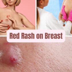 Red Rash on Breast: Causes, Symptoms & Relief