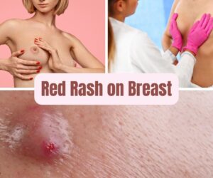 Red Rash on Breast: Causes, Symptoms & Relief