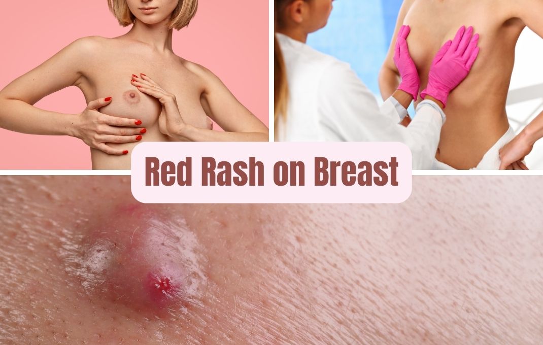 You are currently viewing Red Rash on Breast: Causes, Symptoms & Relief