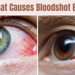 What Causes Bloodshot Eyes: Unveiling Best Hidden Triggers