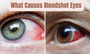 Read more about the article What Causes Bloodshot Eyes: Unveiling Best Hidden Triggers