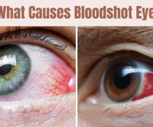 What Causes Bloodshot Eyes: Unveiling Best Hidden Triggers